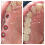 Implant-Testi-Dr-Aeden1