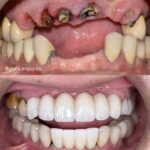 Implant-Testi-Dr-Aeden2