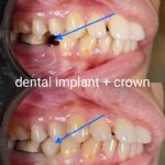 Implant-Testi-Dr-Arthur2