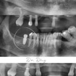 Implant-Testi-Dr-Ding1