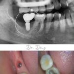 Implant-Testi-Dr-Ding2
