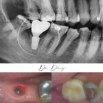 Implant-Testi-Dr-Ding3