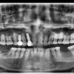 Implant-Testi-Dr-Ding4