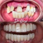 Implant-Testi-Dr-Hazel1
