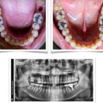 Implant-Testi-Dr-John3