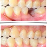 Implant-Testi-Dr-John4