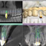 Implant-Testi-Dr-Lau1