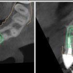 Implant-Testi-Dr-Lau2