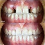 Implant-Testi-Dr-Lau3