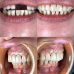 Implant-Testi-Dr-Lau4