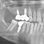 Implant-Testi-Dr-Michelle1