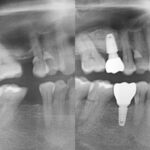 Implant-Testi-Dr-Michelle2
