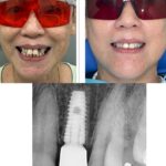 Implant-Testi-Dr-Shaun2