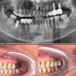 Implant-Testi-Dr-Shaun3