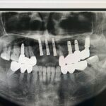 Implant-Testi-Dr-Tan1