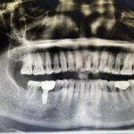 Implant-Testi-Dr-Tan2