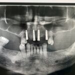 Implant-Testi-Dr-Tan3