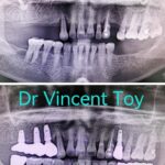 Implant-Testi-Dr-Vincent2
