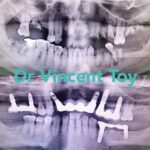 Implant-Testi-Dr-Vincent3