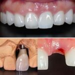 Implant-Testi-Dr-Wayne1