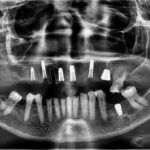 Implant-Testi-Dr-Wayne2