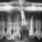 Implant-Testi-Dr-Wayne3