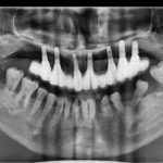 Implant-Testi-Dr-Yew1