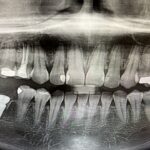 Implant-Testi-Dr-Yew2