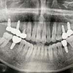 Implant-Testi-Dr-Yew3