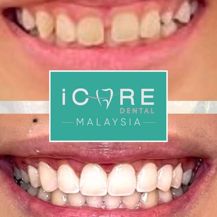 icare-before-after-n1r