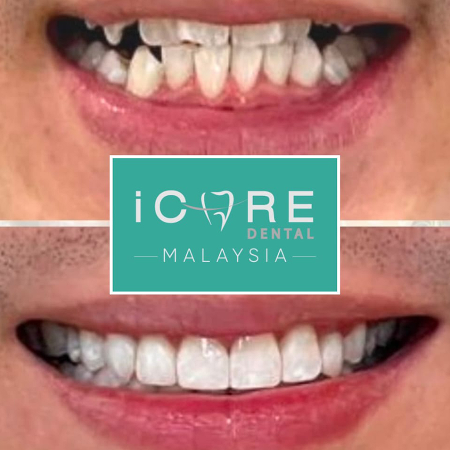 icare-before-after-n2r