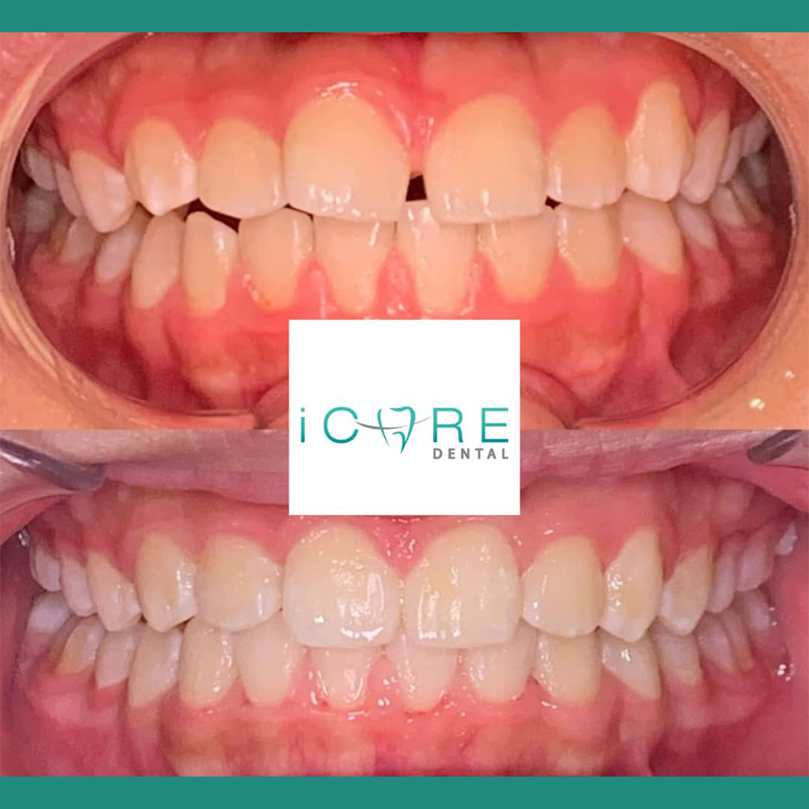 icare-before-after1.jpg