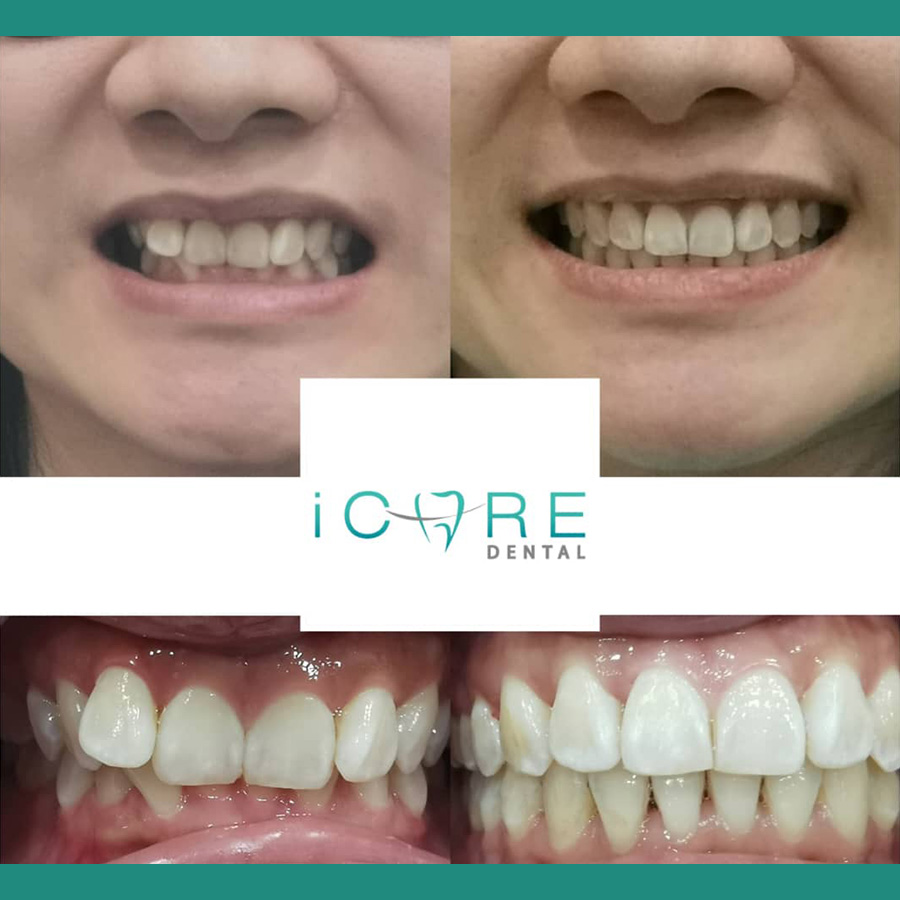 icare-before-after2.jpg