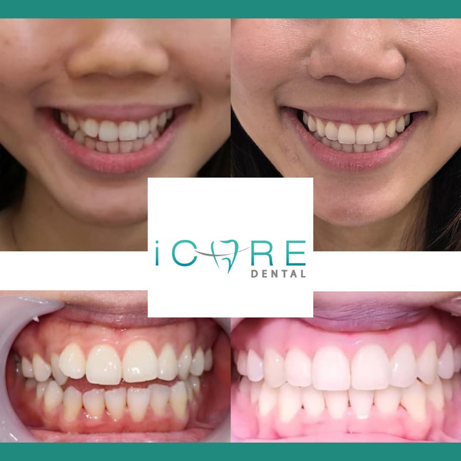 icare-before-after3.jpg