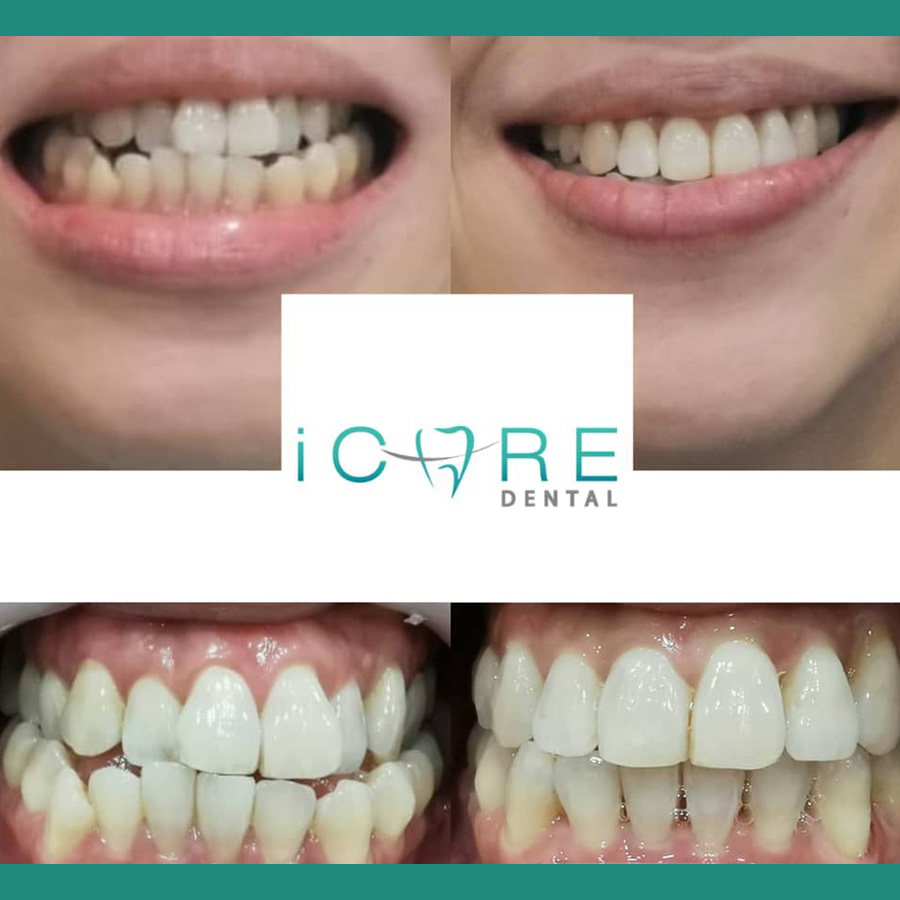 icare-before-after4.jpg