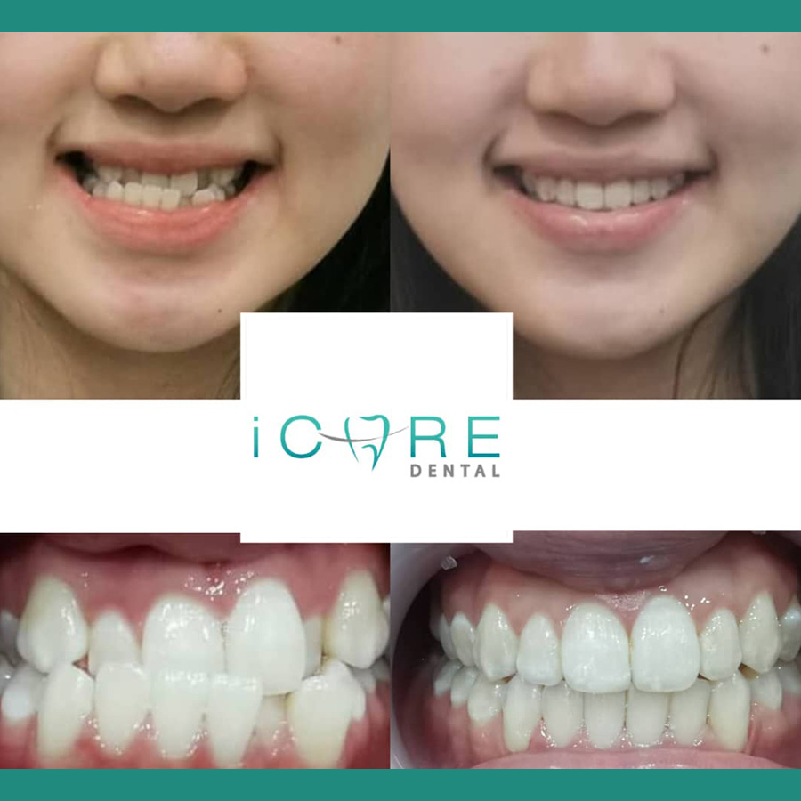 icare-before-after5.jpg
