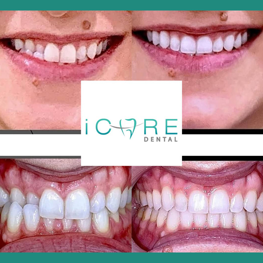 icare-before-after6.jpg