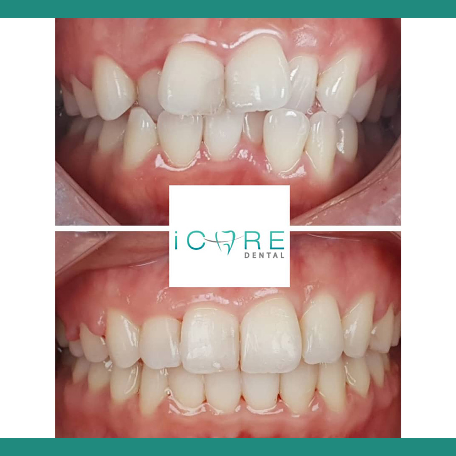 icare-before-after7.jpg