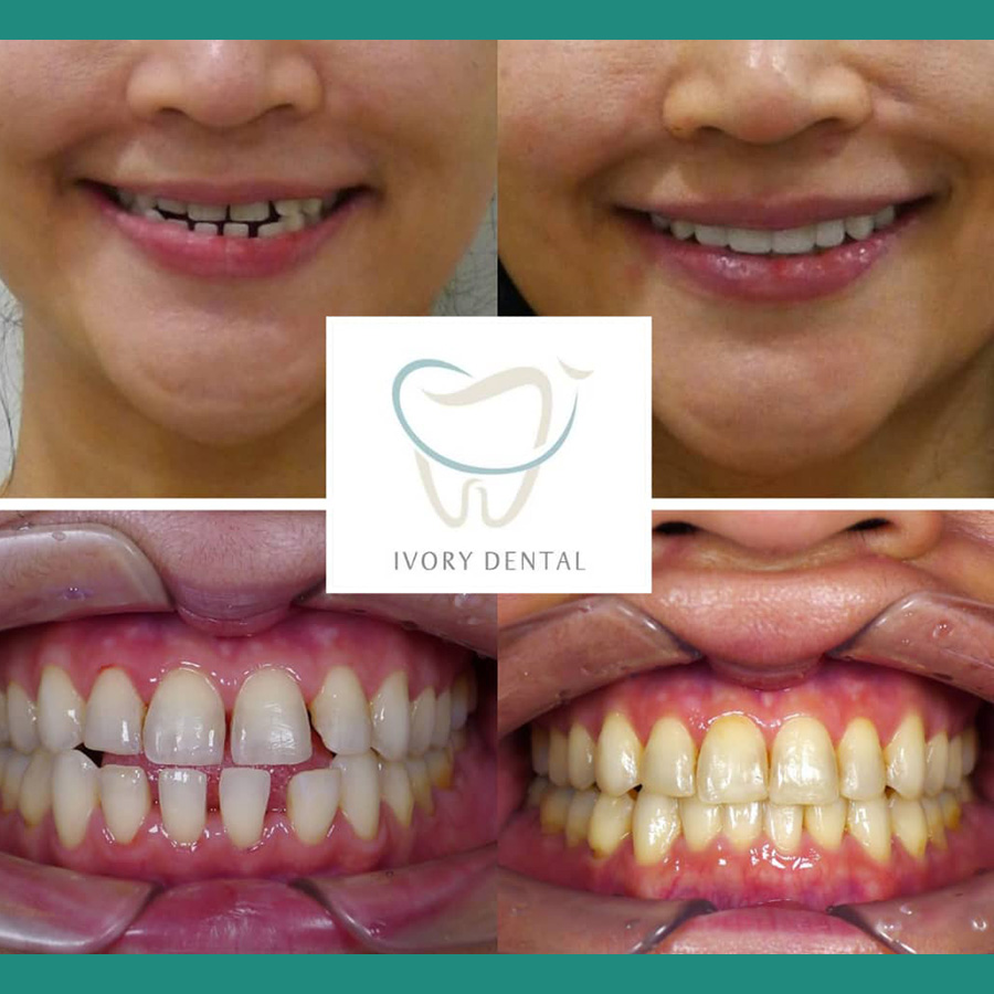 icare-before-after8.jpg